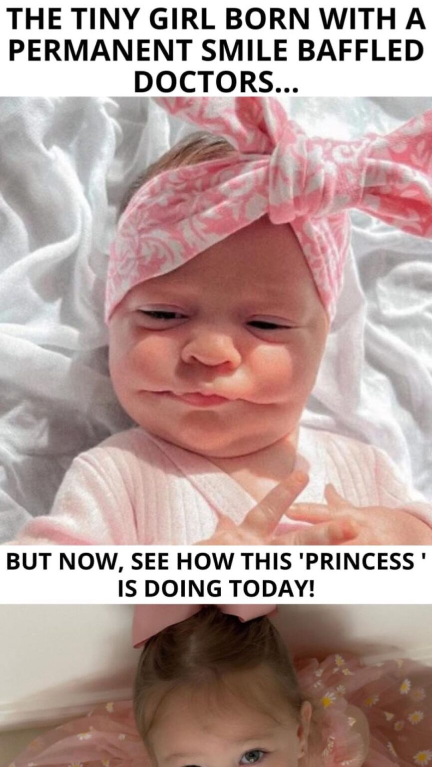 Parents Stunned by Baby’s EartoEar Smile The Shocking Diagnosis